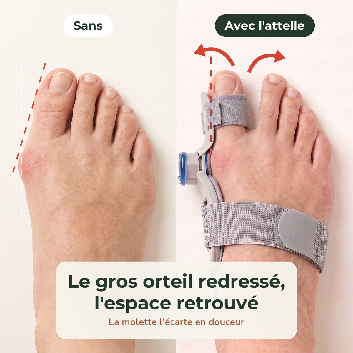 Sans et avec l'attelle : le gros orteil redressé, l'espace retrouvé