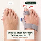 Sans et avec l'attelle : le gros orteil redressé, l'espace retrouvé