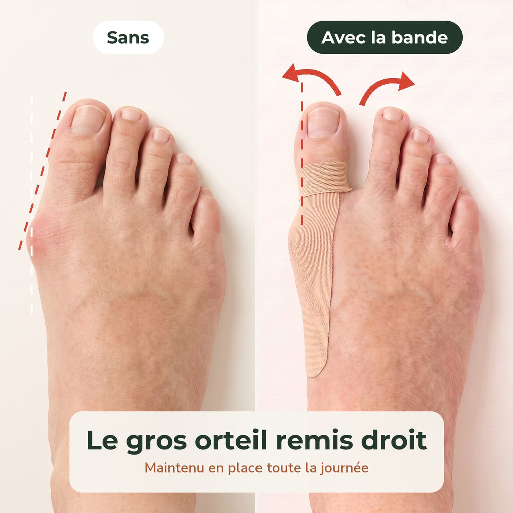 Sans et avec la bande : le gros orteil remis droit